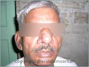 Dr. Arindam Sarkar Gynaecomastia