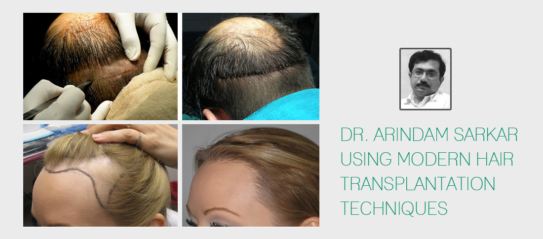 Dr. Arindam Sarkar using modern hair transplantation techniques
