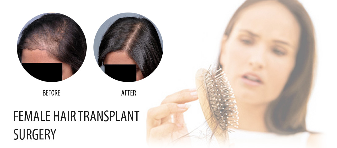 Female hair transplant surgery