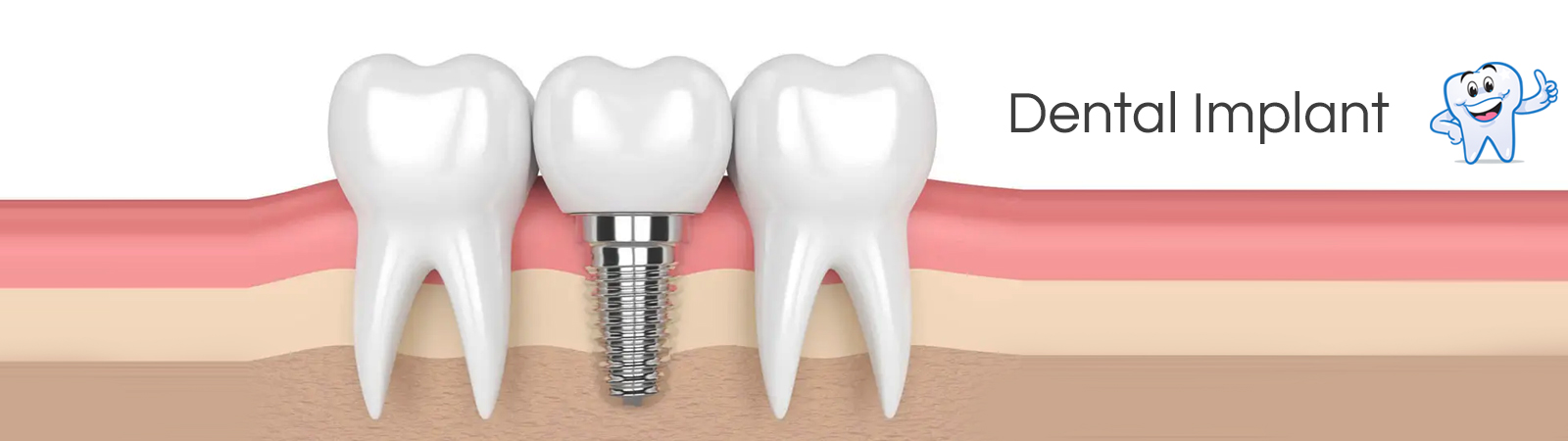 Dental Implant