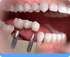 Dental Implant