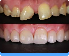 Full Mouth Occlusal Rehabilitation