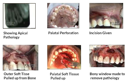 Apicoectomy