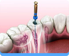 Surgical Endodontics - Apicoectomy, Hemisectom, Radisectomyy, Bicuspidizationt