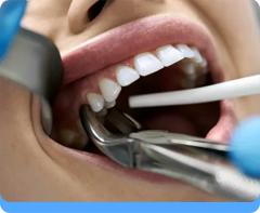 Surgical Procedure for Simple Extraction, Trans Alveolar Extraction 