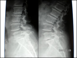 Dynamic Fixations of The Lumbar Spine (DIAM