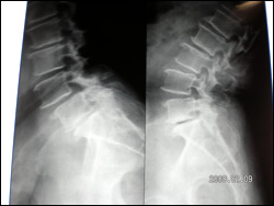 Dynamic Fixations of The Lumbar Spine (DIAM