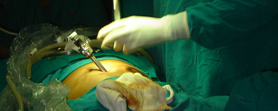 Hysteroscopy Surgery