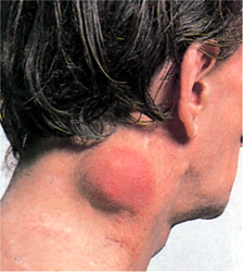 non-Hodgkin lymphoma