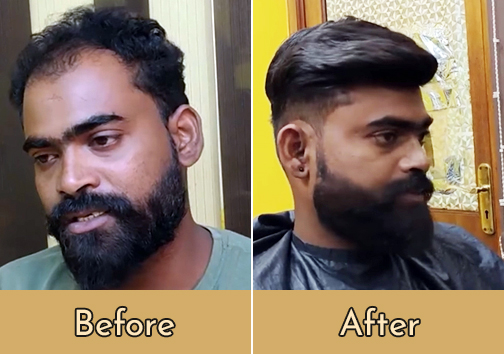 Hair Patch Cost in Kolkata
