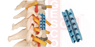 Spinal, Cranial, Maxillofacial & Arthroplasty Implants