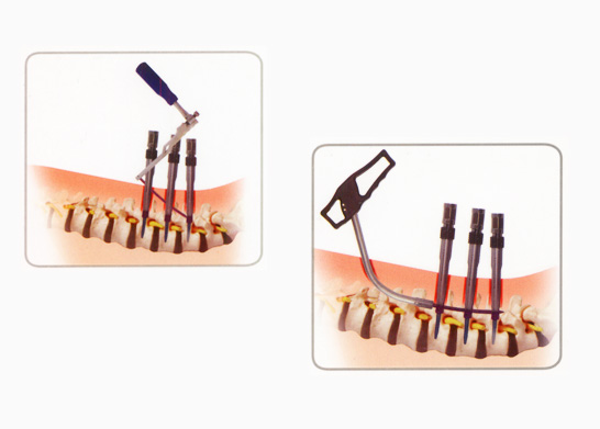 Neha Surgical - Authorised Dealer of Spinal Implants, Instruments and Hospital Equipments