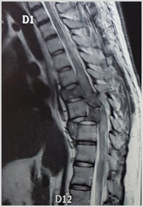 Spinal Trauma Pre Ooperation