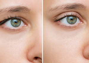 Removal of Baggy Eyelids