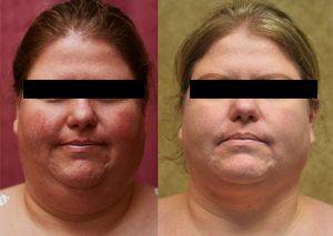 Cheek Liposuction