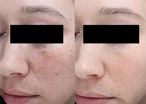 Facial Chemical Peeling