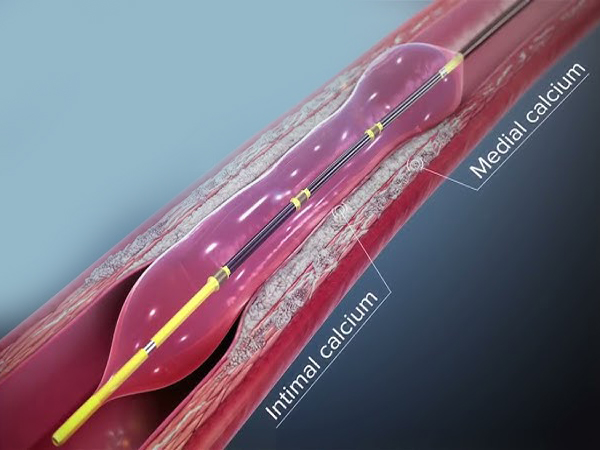 Intravascular Lithotripsy (IVL)