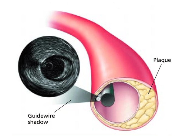 Intravascular Ultrasound (IVUS)