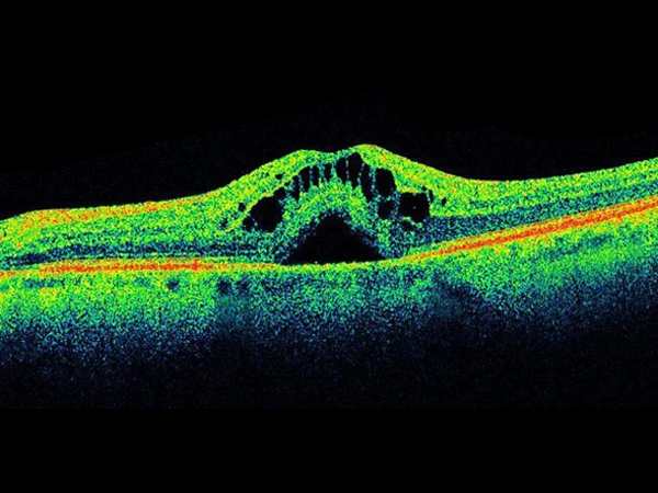 Optical Coherence Tomography (OCT)