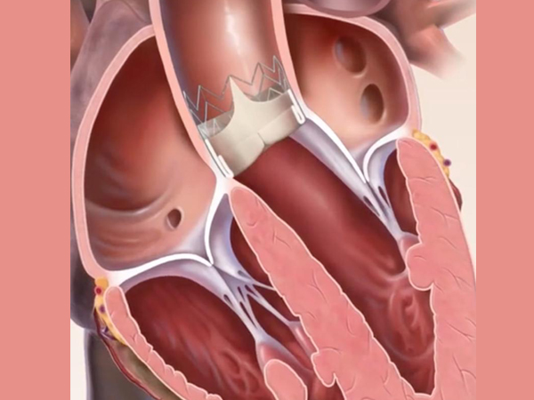 Structural Heart Disease Treatments in Kolkata