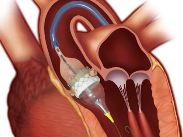 TAVR (Transcatheter Aortic Valve Replacement)