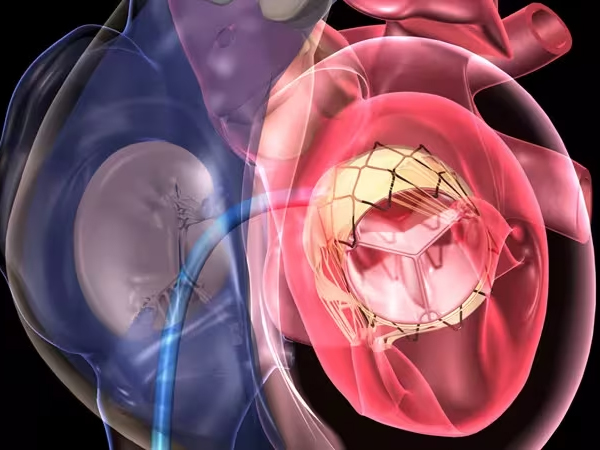 TMVR (Transcatheter Mitral Valve Replacement)